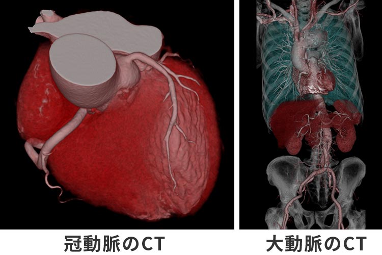 冠動脈のCT | 大動脈のCT